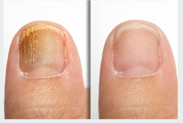 unhas